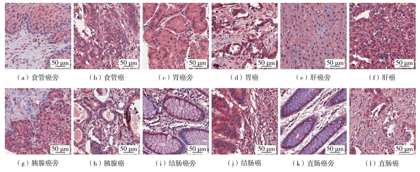 图1 免疫组织化学染色显示STOML1蛋白质在6种消化系统癌和癌旁组织中的表达情况Fig. 1 STOML1 protein expression in six cancerous and paracancerous tissues of digestive system by immunohistochemical staining