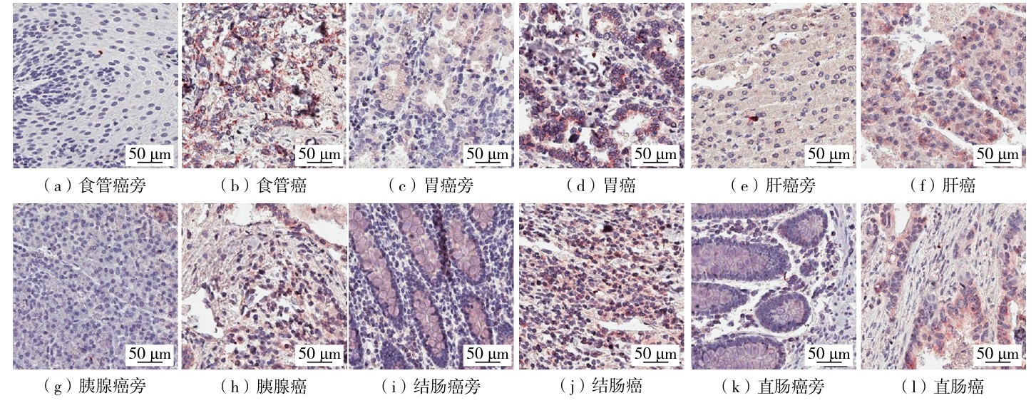 图3 免疫组织化学染色显示STOML2蛋白质在消化系统6种癌和癌旁组织中的表达情况Fig. 3 STOML2 protein expression in six cancerous and paracancerous tissues of digestive system by immunohistochemical staining