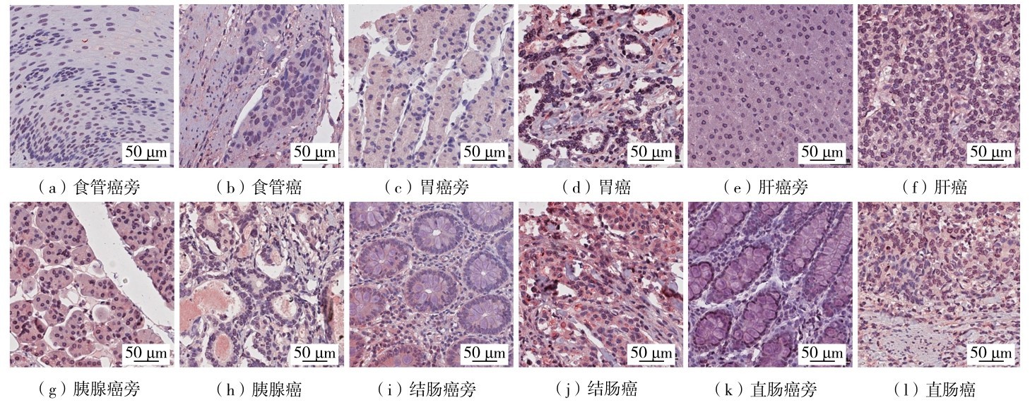 图5 免疫组织化学染色显示TAF1L蛋白质在消化系统癌和癌旁组织中的表达情况Fig. 5 TAF1L protein expression in six cancerous and paracancerous tissues of digestive system by immunohistochemical staining