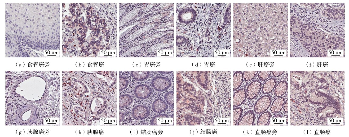 图7 免疫组织化学染色显示MMP9蛋白质在消化系统癌和癌旁组织中的表达情况Fig. 7 MMP9 protein expression in six cancerous and paracancerous tissues of digestive system by immunohistochemiscal staining