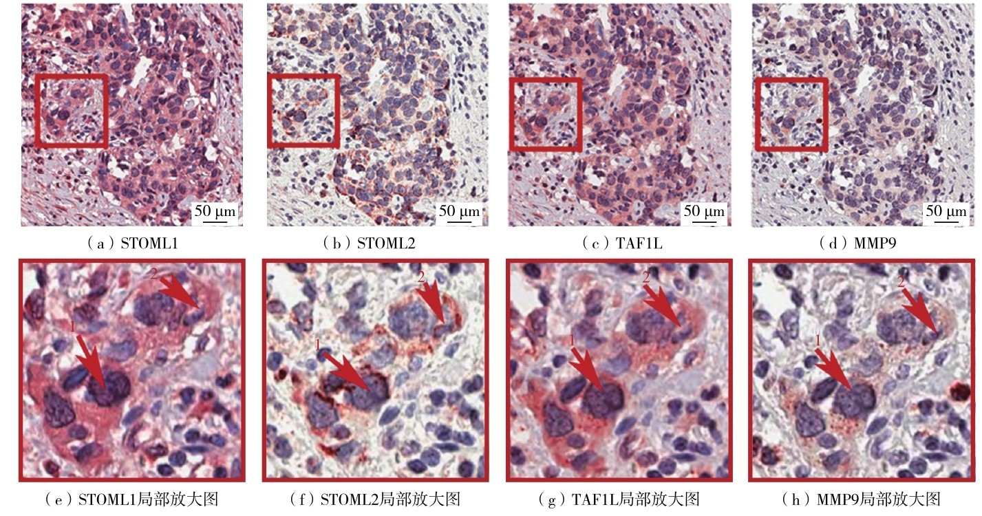 图8 多重IHC染色显示STOML1、STOML2、TAF1L和MMP9蛋白质在同一癌组织细胞中的表达情况Fig. 8 STOML1、STOML2、TAF1L and MMP9 protein expressions in the same tumor cells by multiple immunohistochemical staining. (e)-(h) are enlarged images in the square regins of (a)-(d), respectively.
