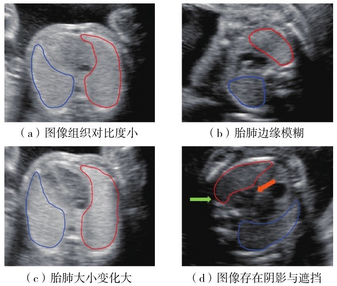 图1 胎肺三维超声图像分割困难示例Fig. 1 Examples of difficulties in segmenting fetal lung three-dimensional ultrasound images